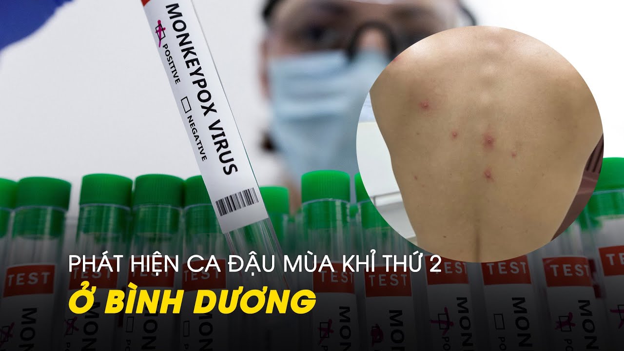 Bình Dương phát hiện ca đậu mùa khỉ thứ hai