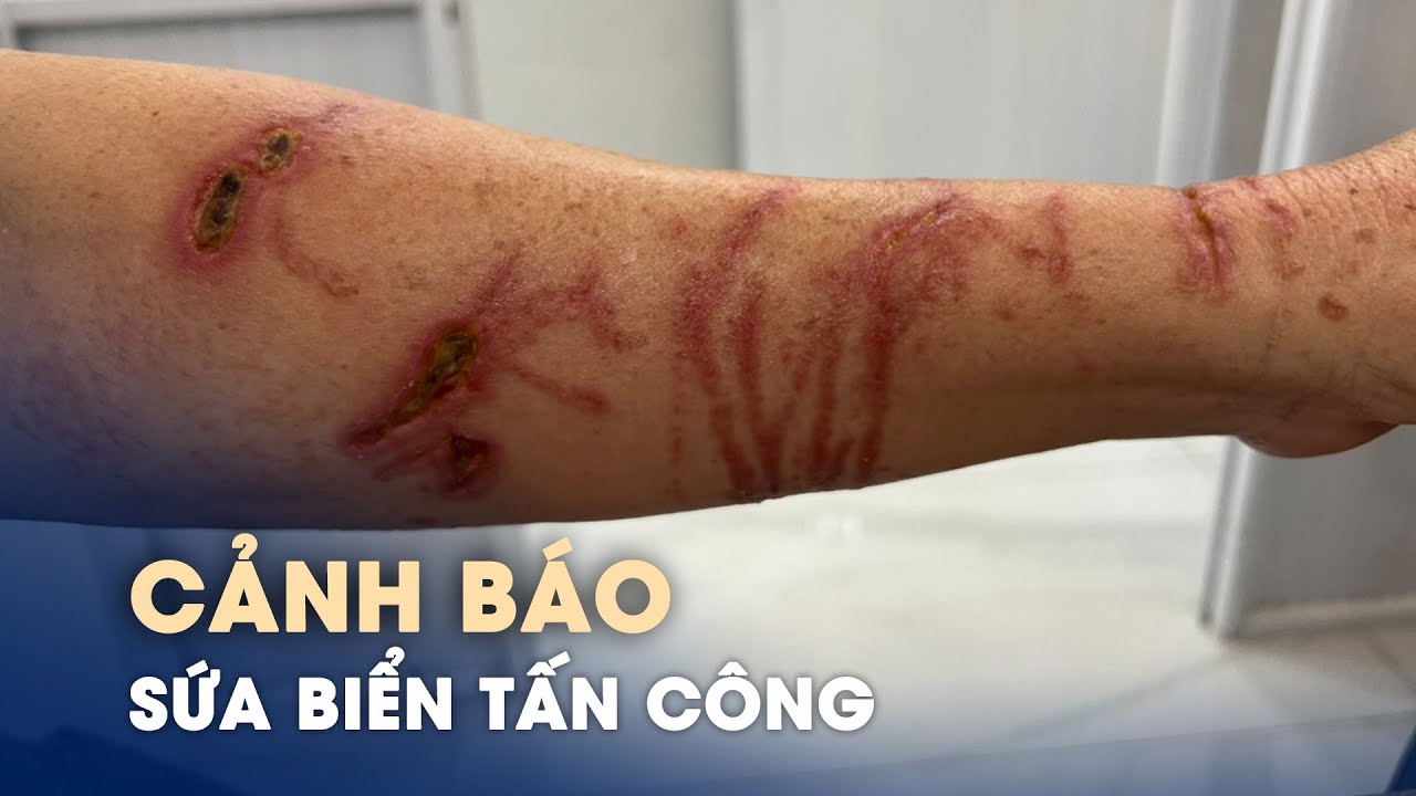 Sứa biển tấn công, đừng chủ quan!