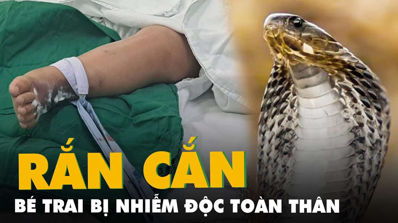 Bị rắn hổ mèo cắn, bé trai bị nhiễm độc toàn thân