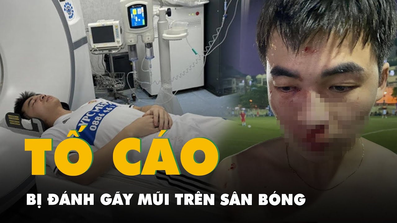 Công an xác minh vụ nam thanh niên tố bị đánh gãy mũi trên sân bóng đá phủi