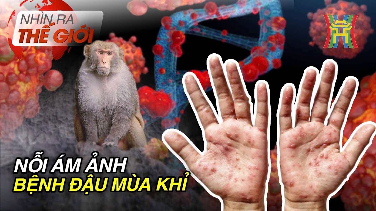 Nỗi ám ảnh về bệnh đậu mùa khỉ | Nhìn ra thế giới | Tin quốc tế