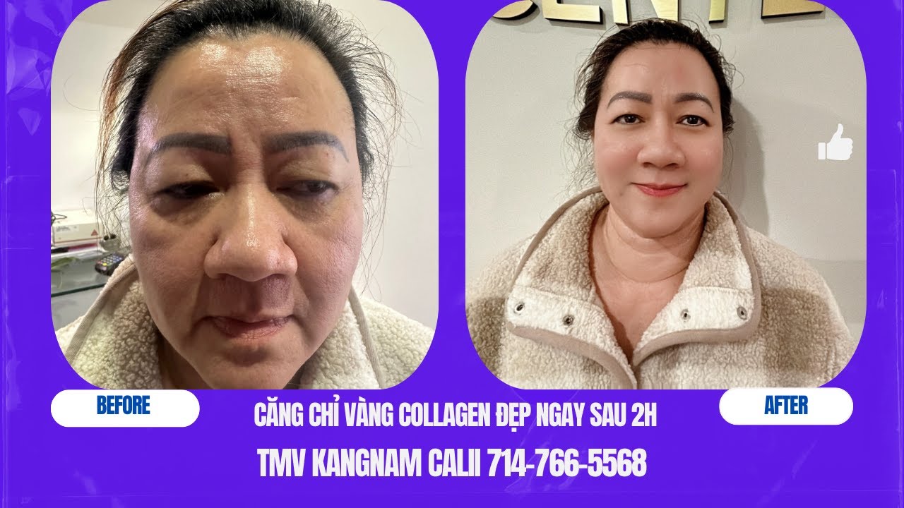 Toàn cảnh căng chỉ vàng collagen tươi kết hợp Miso trẻ hoá, săn, sáng tươi trẻ đẹp cả mặt chỉ 2h