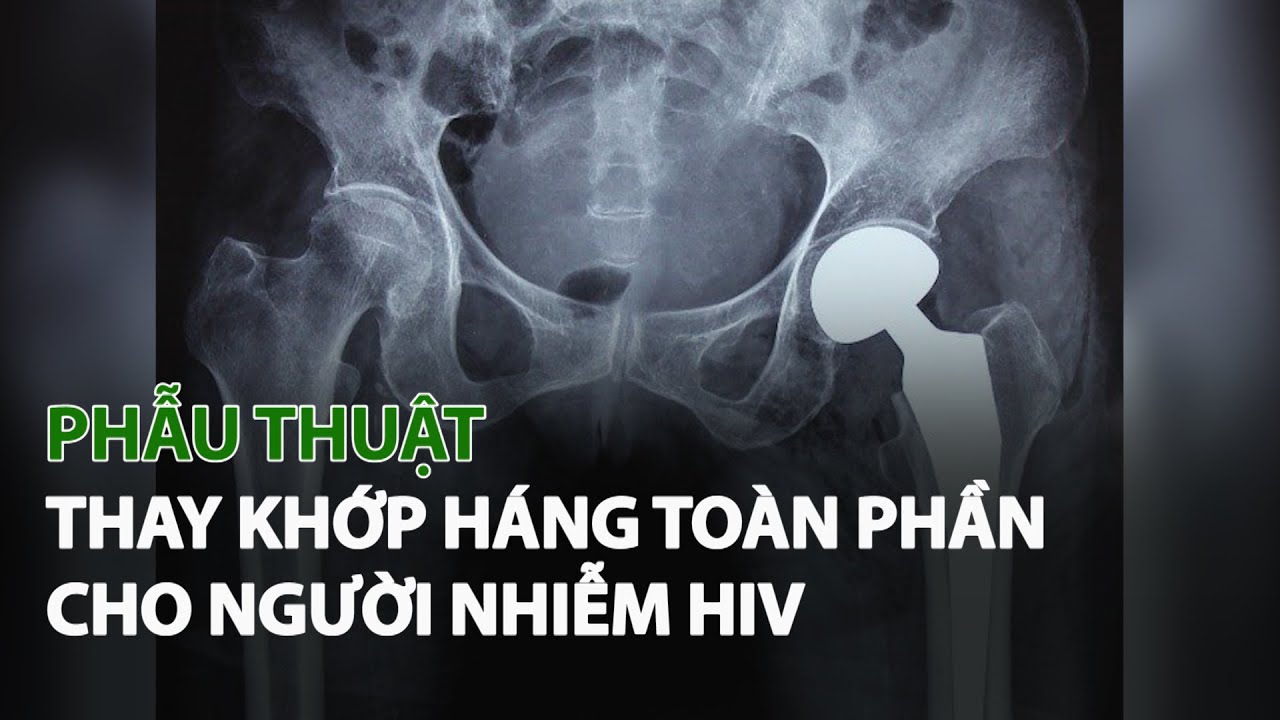 Phẫu thuật thay Khớp Háng Toàn Phần cho người Nhiễm HIV| VTC14