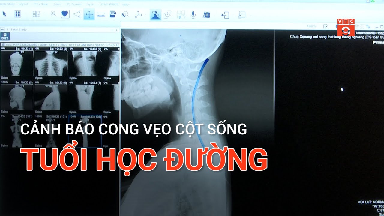 CẢNH BÁO CONG VẸO CỘT SỐNG TUỔI HỌC ĐƯỜNG | VTC9