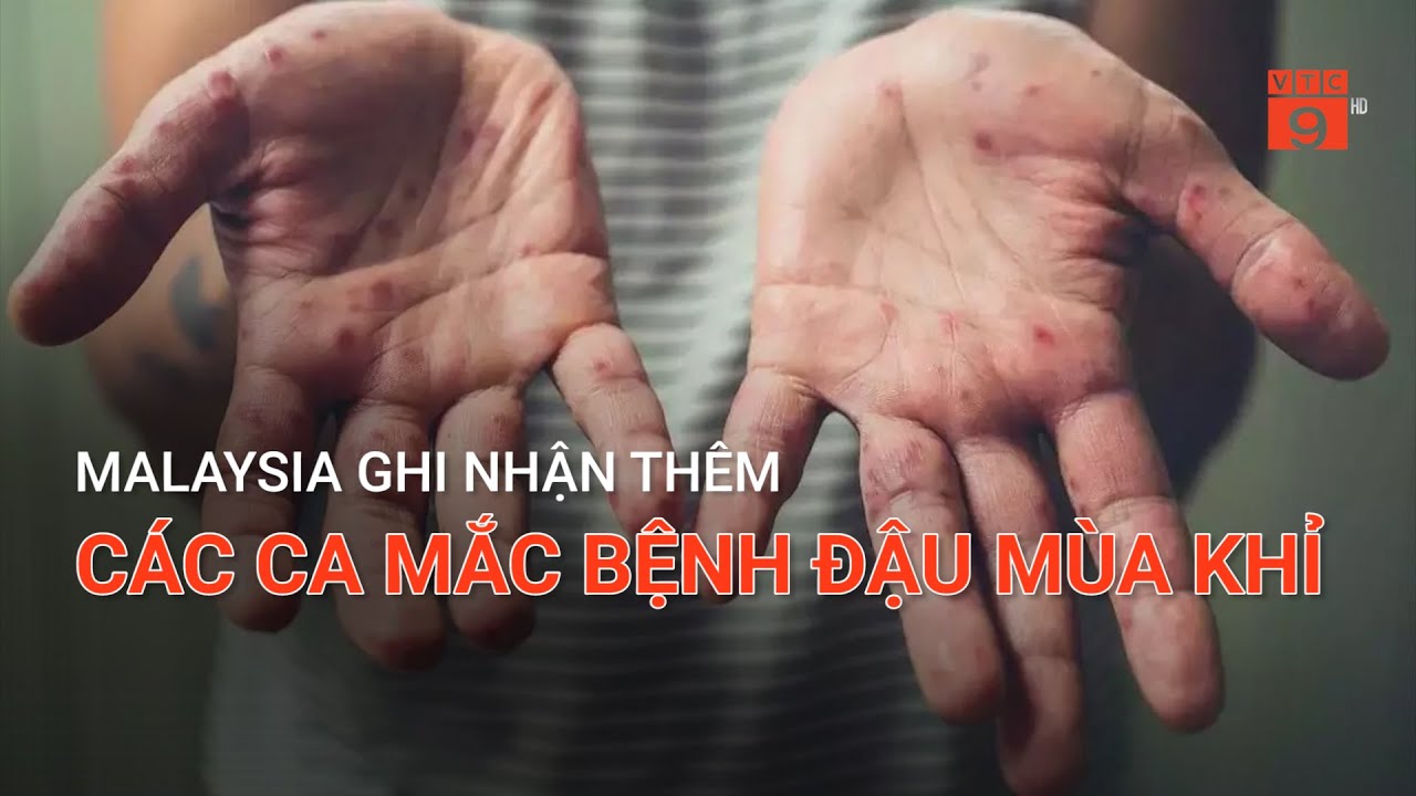 MALAYSIA GHI NHẬN THÊM CÁC CA MẮC BỆNH ĐẬU MÙA KHỈ | VTC9