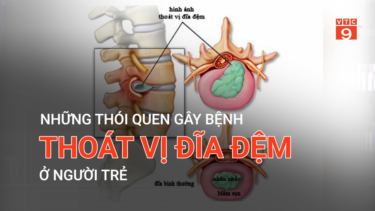 NHỮNG THÓI QUEN GÂY BỆNH THOÁT VỊ ĐĨA ĐỆM Ở NGƯỜI TRẺ | VTC9