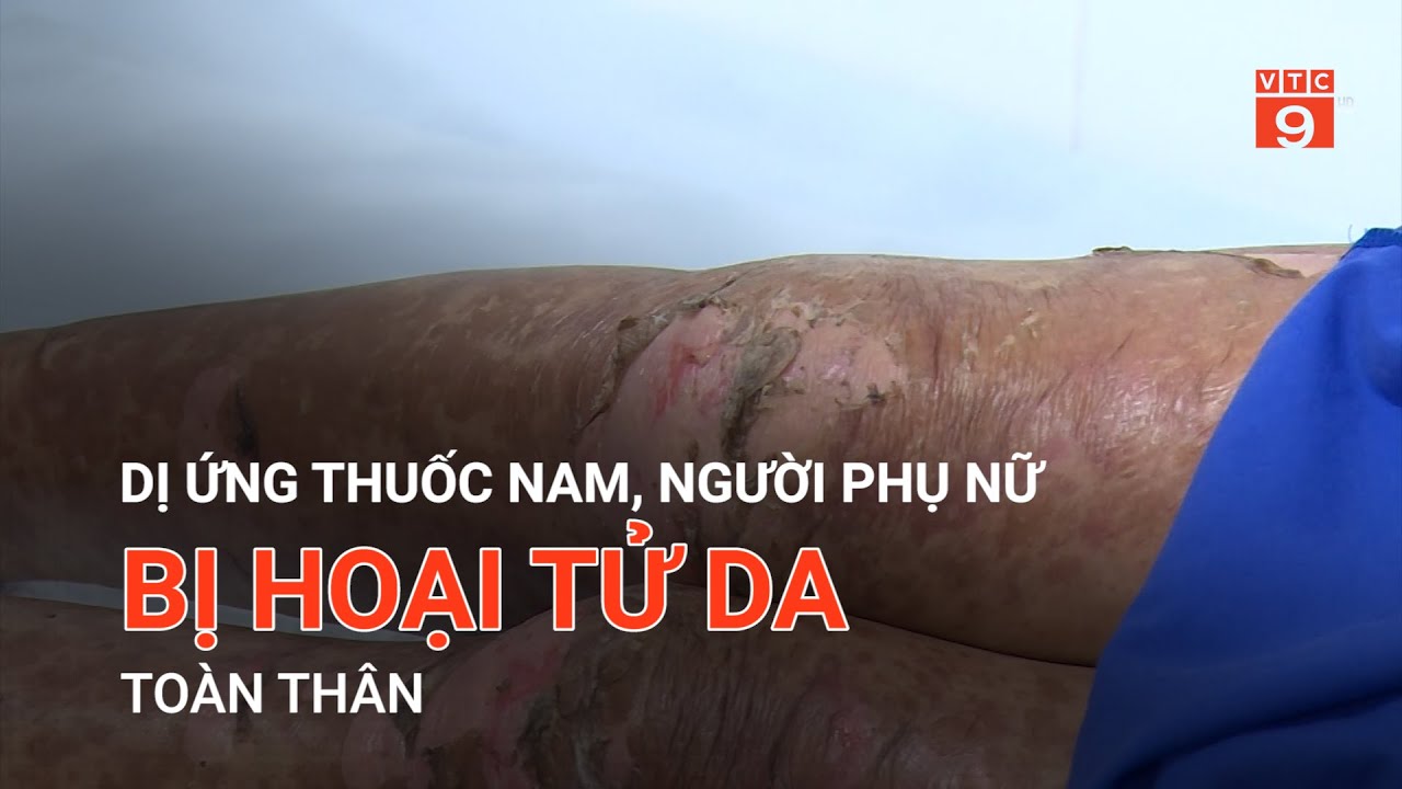 DỊ ỨNG THUỐC NAM, NGƯỜI PHỤ NỮ BỊ HOẠI TỬ DA TOÀN THÂN | VTC9