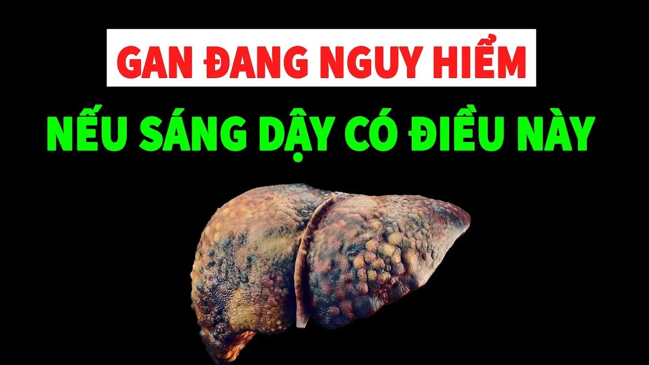 Nếu buổi sáng thức dậy có 4 biểu hiện này Gan của bạn đang nguy hiểm