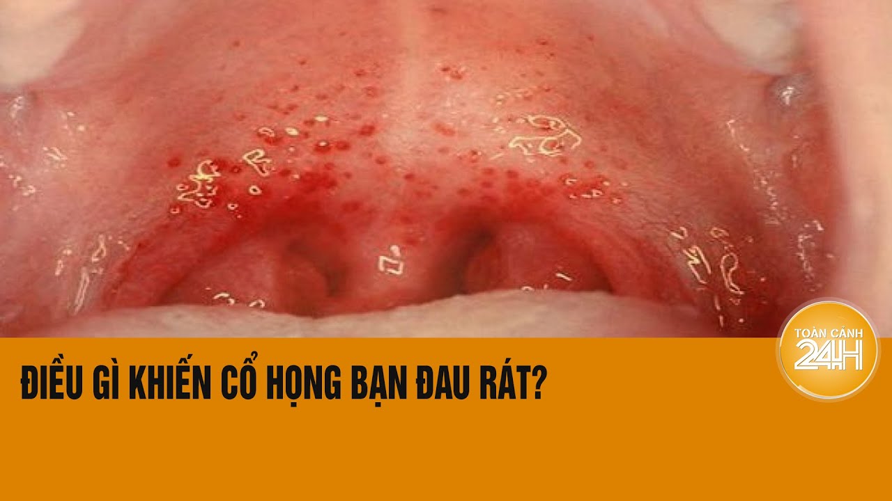 Điều gì khiến cổ họng của bạn đau rát và cách điều trị bệnh hiệu quả | Toàn cảnh 24h