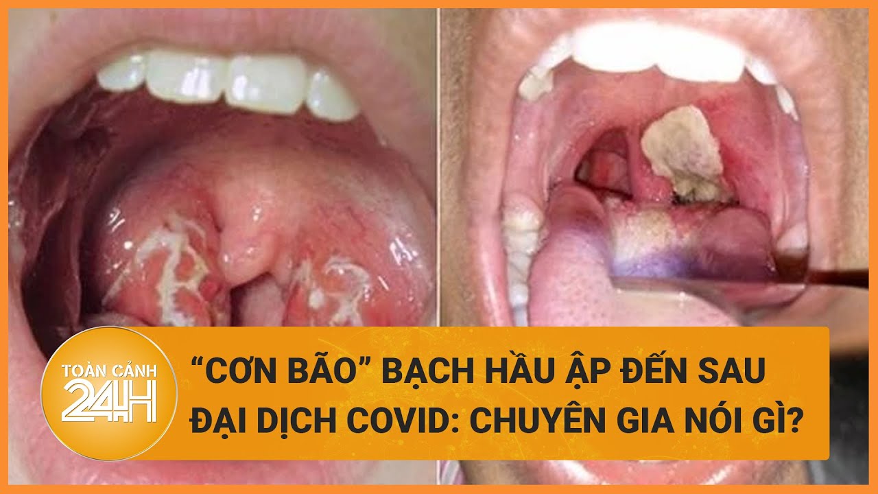 “Cơn bão” bạch hầu ập đến, nguy cơ trở thành dịch, chuyên gia cảnh báo nguồn lây lan nhanh chóng