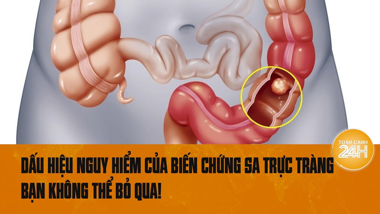 Sa trực tràng: Những biến chứng nguy hiểm và những dấu hiệu bạn không thể bỏ qua | Toàn cảnh 24h