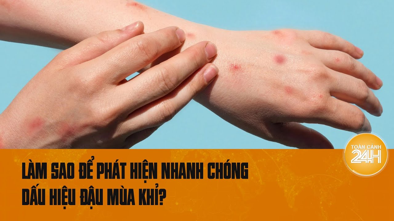 Nhanh chóng phát hiện bệnh đậu mùa khỉ nhờ dấu hiệu này | Toàn cảnh 24h