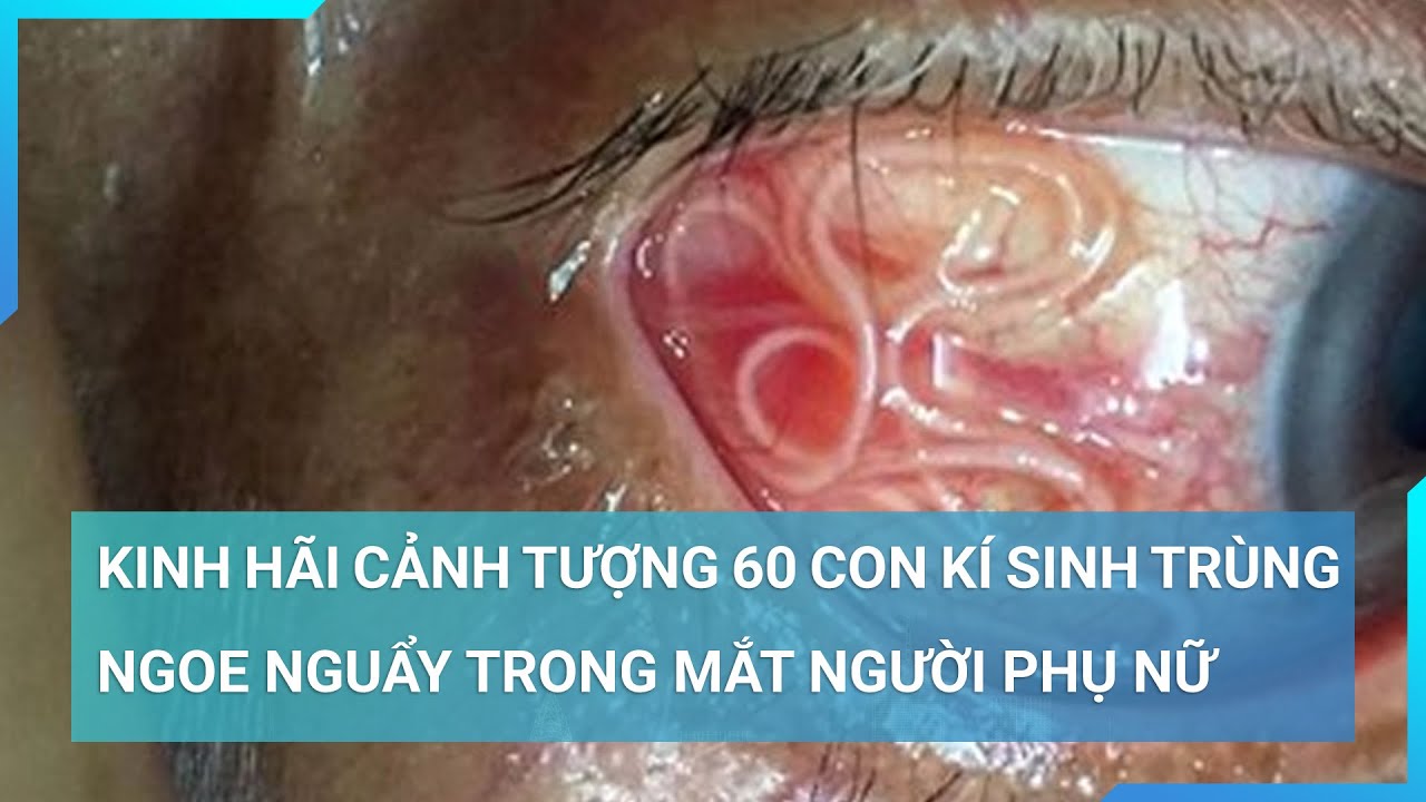 Kinh hãi cảnh tượng 60 con kí sinh trùng ngoe nguẩy trong mắt người phụ nữ | Cuộc sống 24h