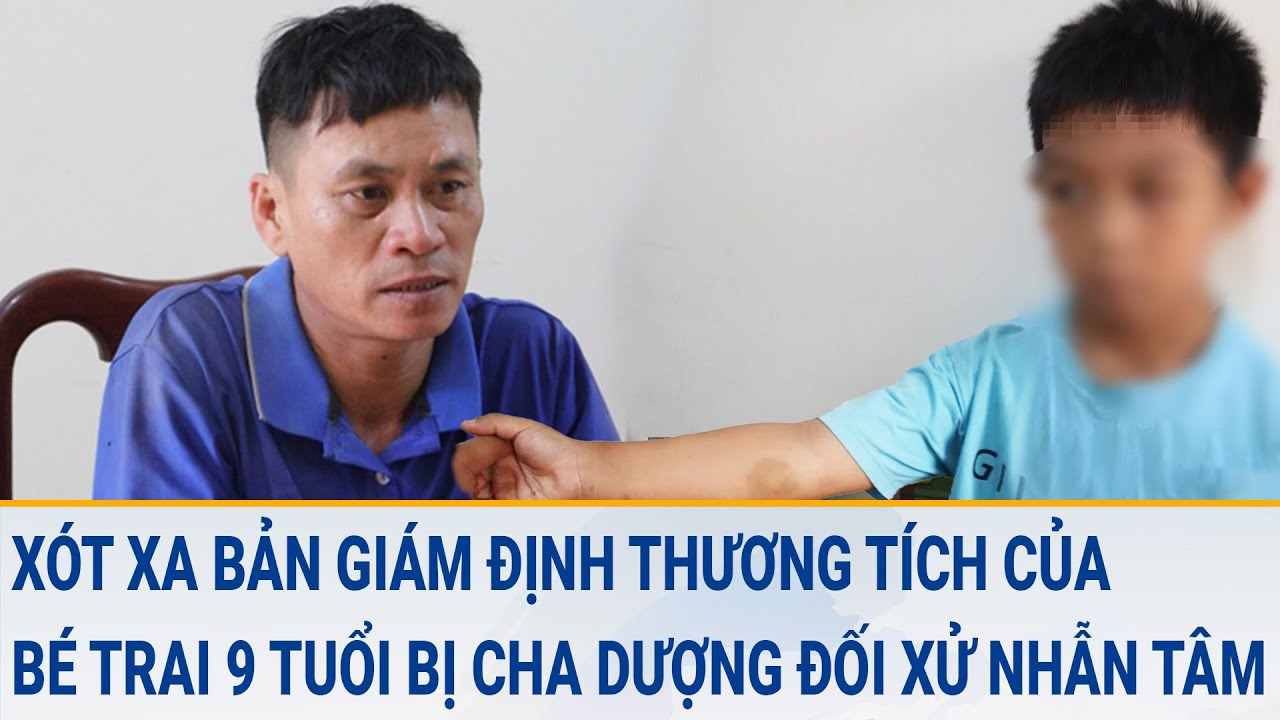 Xót xa bản giám định của bé trai 9 tuổi bị cha dượng ra tay gây thương tích