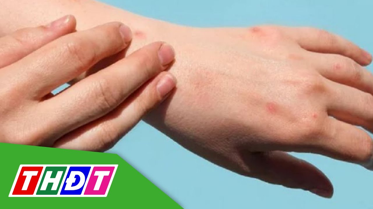 TP.HCM: 60% ca đậu mùa khỉ là người nhiễm HIV | THDT