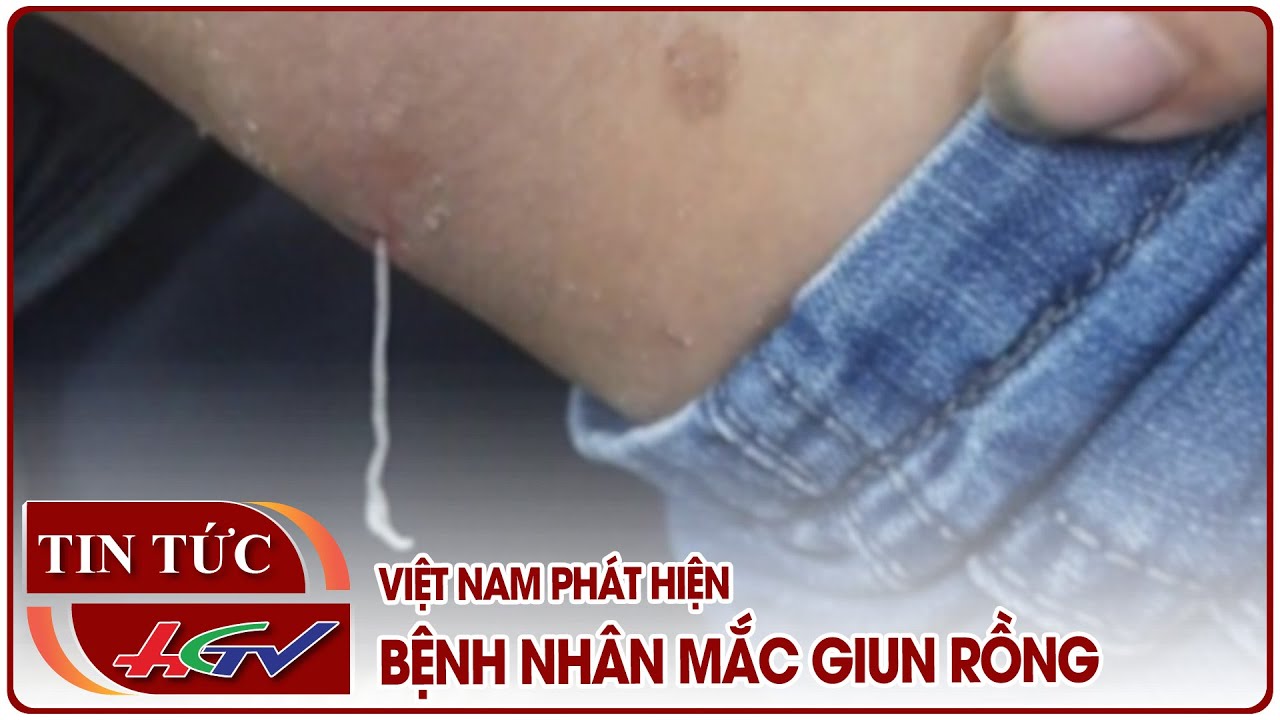 Việt Nam phát hiện bệnh nhân mắc giun rồng | Truyền hình Hậu Giang