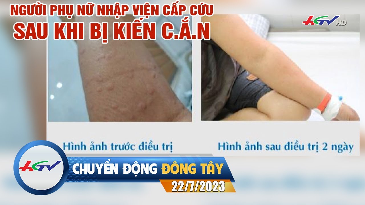 Người phụ nữ nhập viện cấp cứu sau khi bị kiến c.ắ.n | Chuyển động Đông Tây 22/7/2023