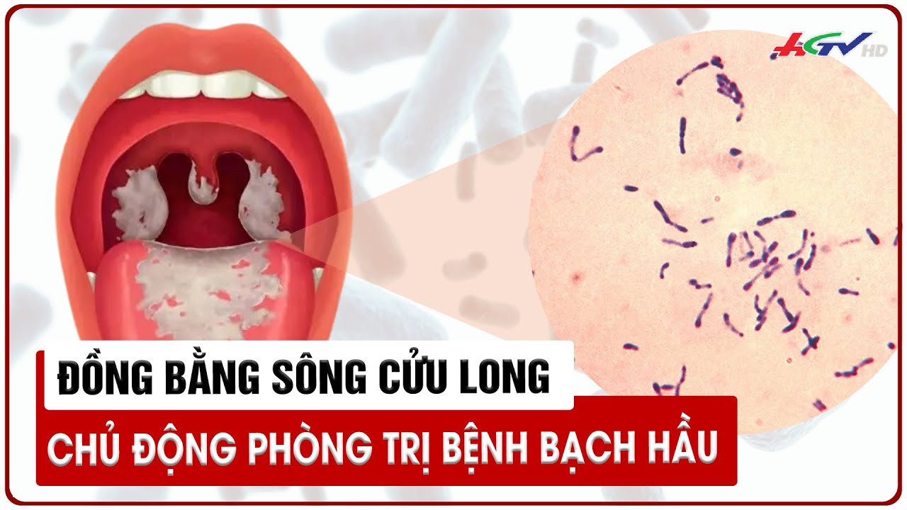 ĐBSCL chủ động phòng trị bệnh bạch hầu | Truyền hình Hậu Giang