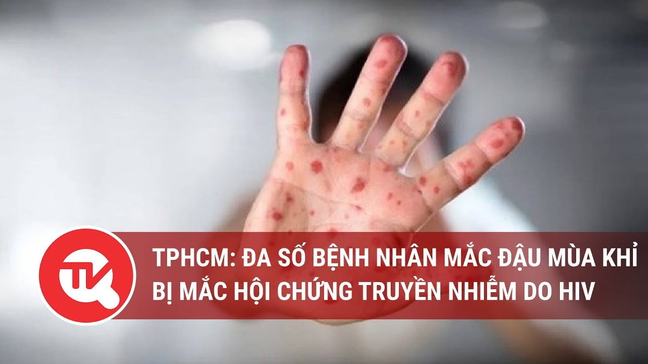 TPHCM: Đa số bệnh nhân mắc đậu mùa khỉ bị mắc hội chứng truyền nhiễm do HIV