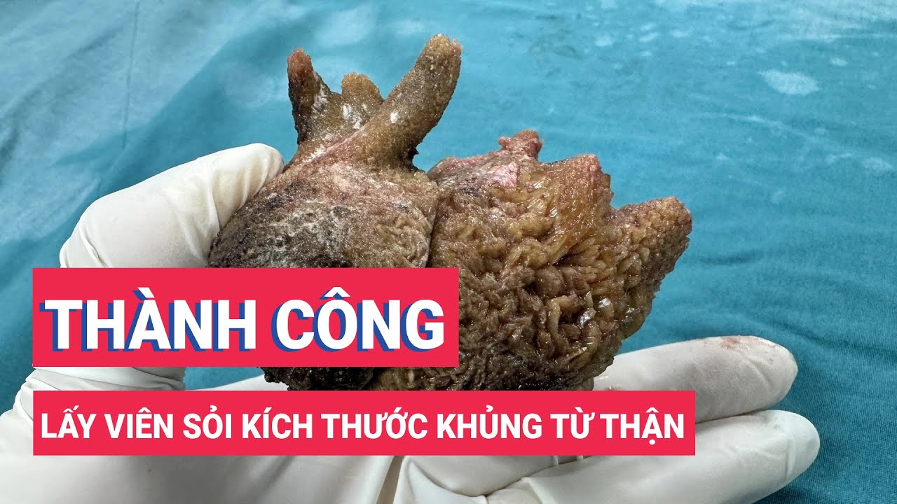 Lấy thành công viên sỏi kích thước khủng từ thận người đàn ông trung niên