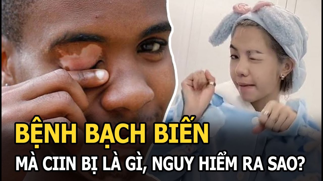 Bệnh bạch biến mà CiiN bị là gì, nguy hiểm ra sao?