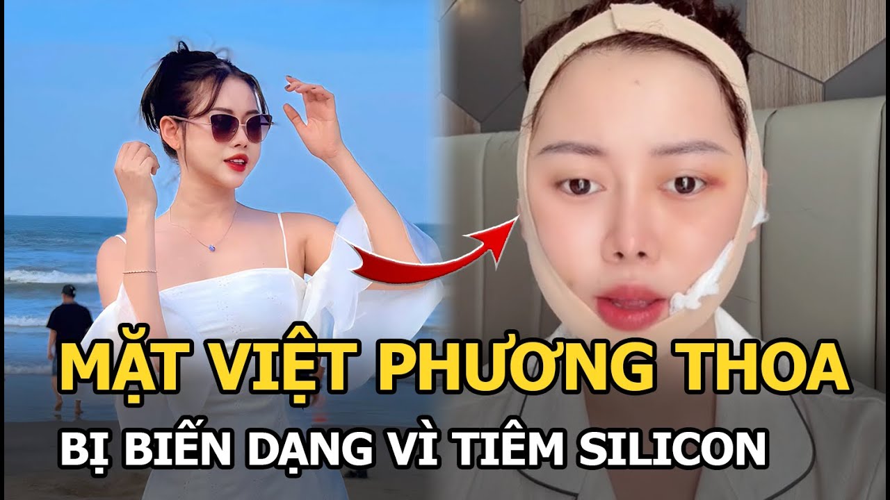 Mặt Việt Phương Thoa bị biến dạng vì tiêm silicon