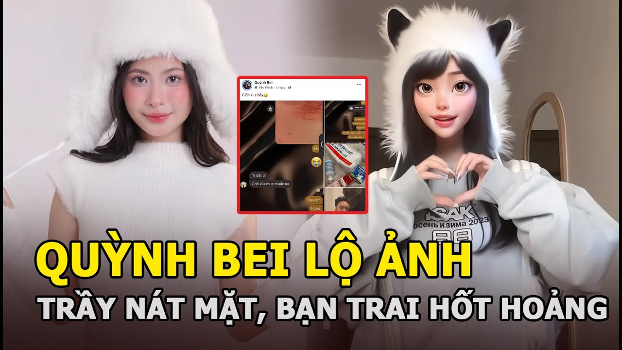 Quỳnh Bei lộ ảnh trầy nát mặt, bạn trai hốt hoảng