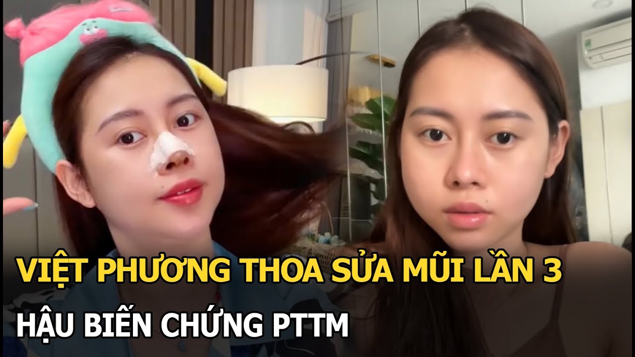 Việt Phương Thoa sửa mũi lần 3 hậu biến chứng PTTM