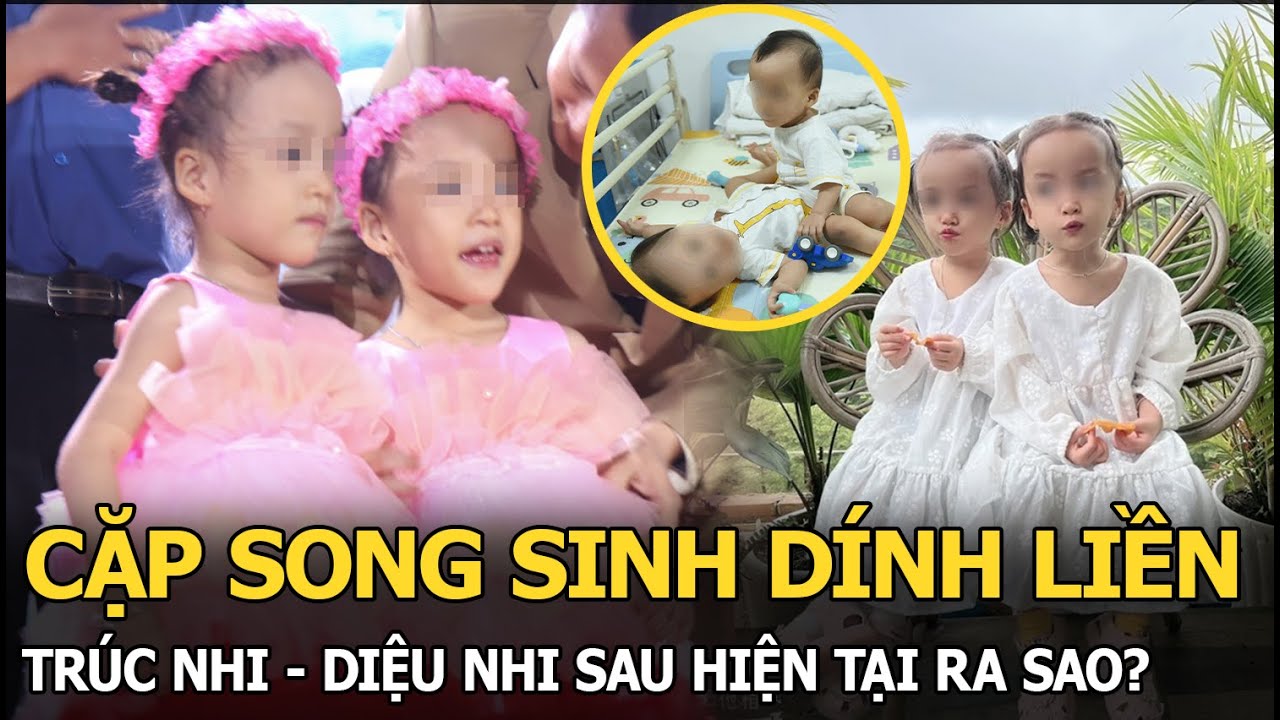 Cặp song sinh dính liền Trúc Nhi - Diệu Nhi sau hơn 3 năm làm đại phẫu tách rời, hiện tại ra sao?