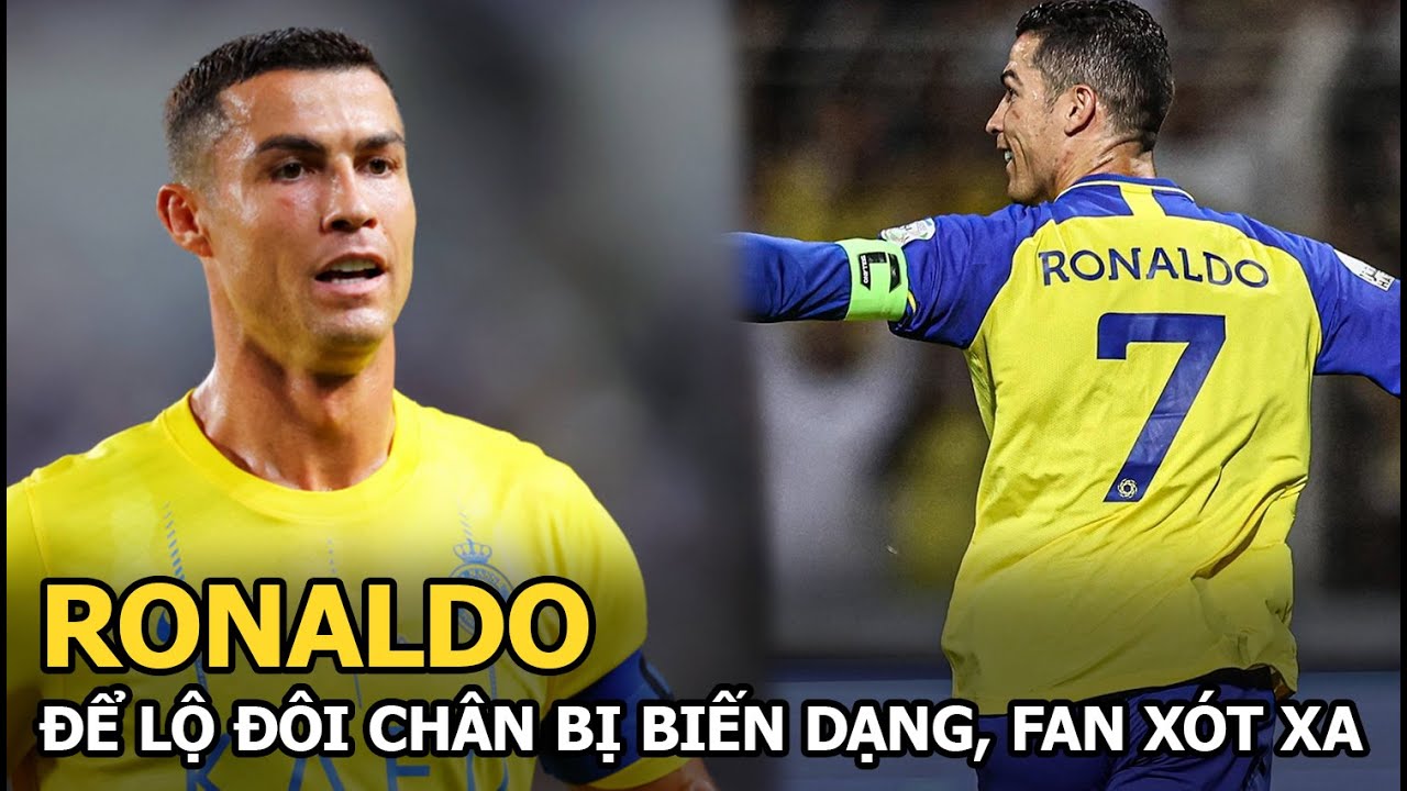 Ronaldo để lộ đôi chân bị biến dạng, fan xót xa