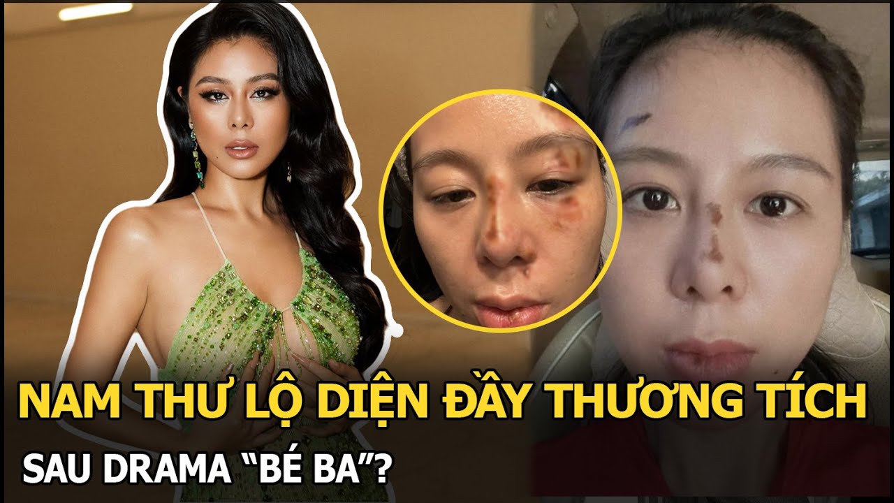 Nam Thư lộ diện đầy thương tích sau drama “bé ba”?