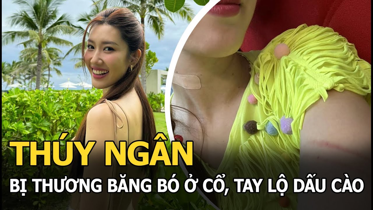 Thúy Ngân thương tích đầy mình, lộ vết băng ngay cổ, dấu cào dài ở tay, “thủ phạm” công khai xin lỗi