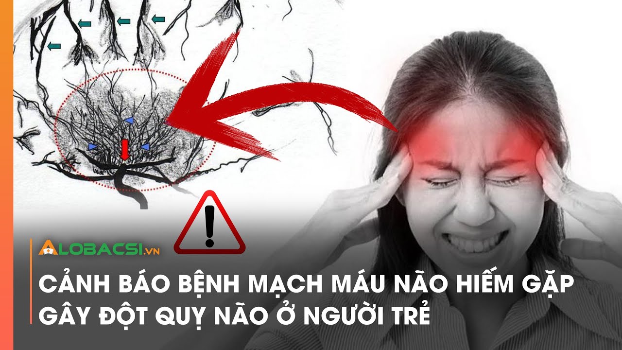 Cảnh báo bệnh mạch máu não hiếm gặp gây đột quỵ não ở người trẻ | Video Alobacsi