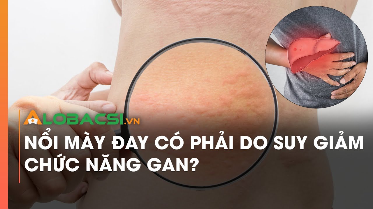 Nổi mày đay có phải do suy giảm chức năng gan?