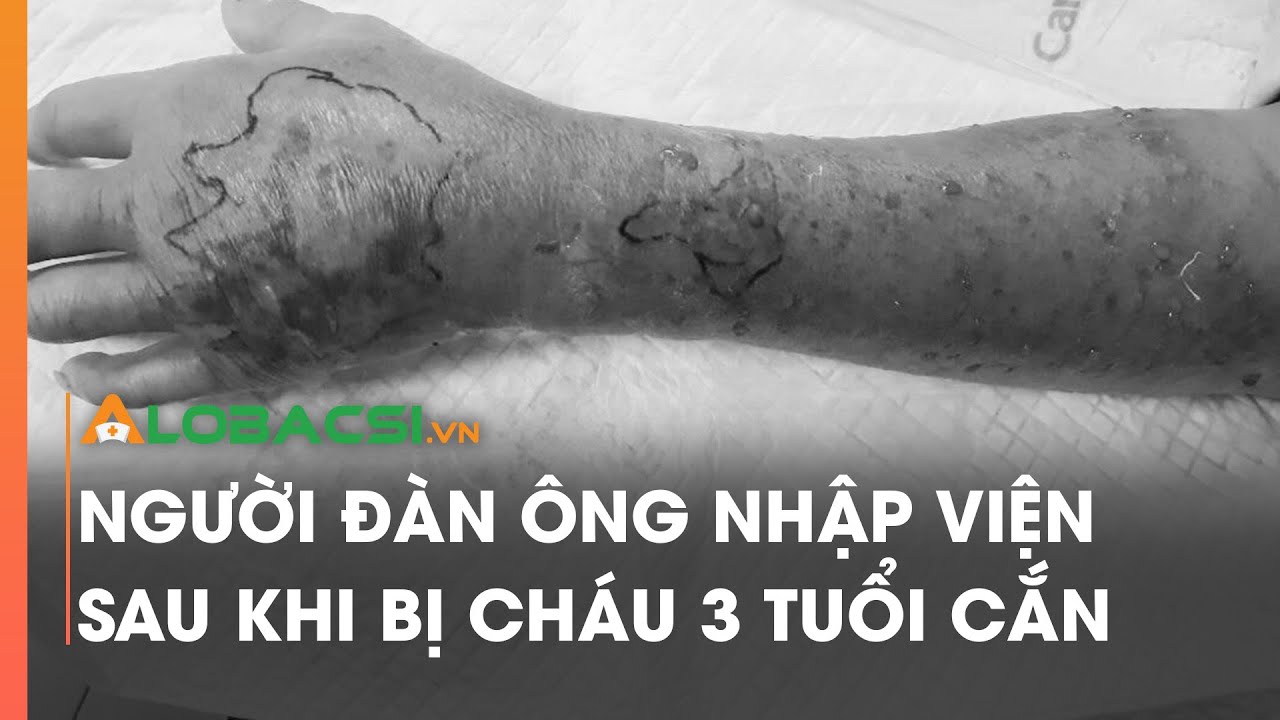 Người đàn ông nhập viện sau khi bị cháu 3 tuổi cắn