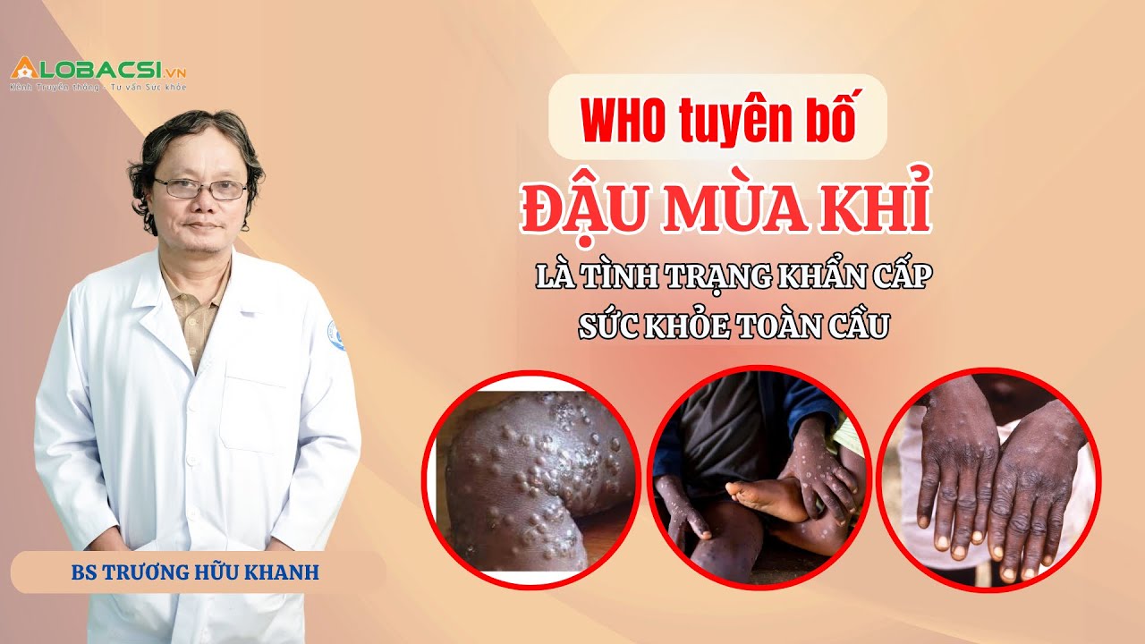 WHO tuyên bố đậu mùa khỉ là tình trạng khẩn cấp sức khỏe toàn cầu