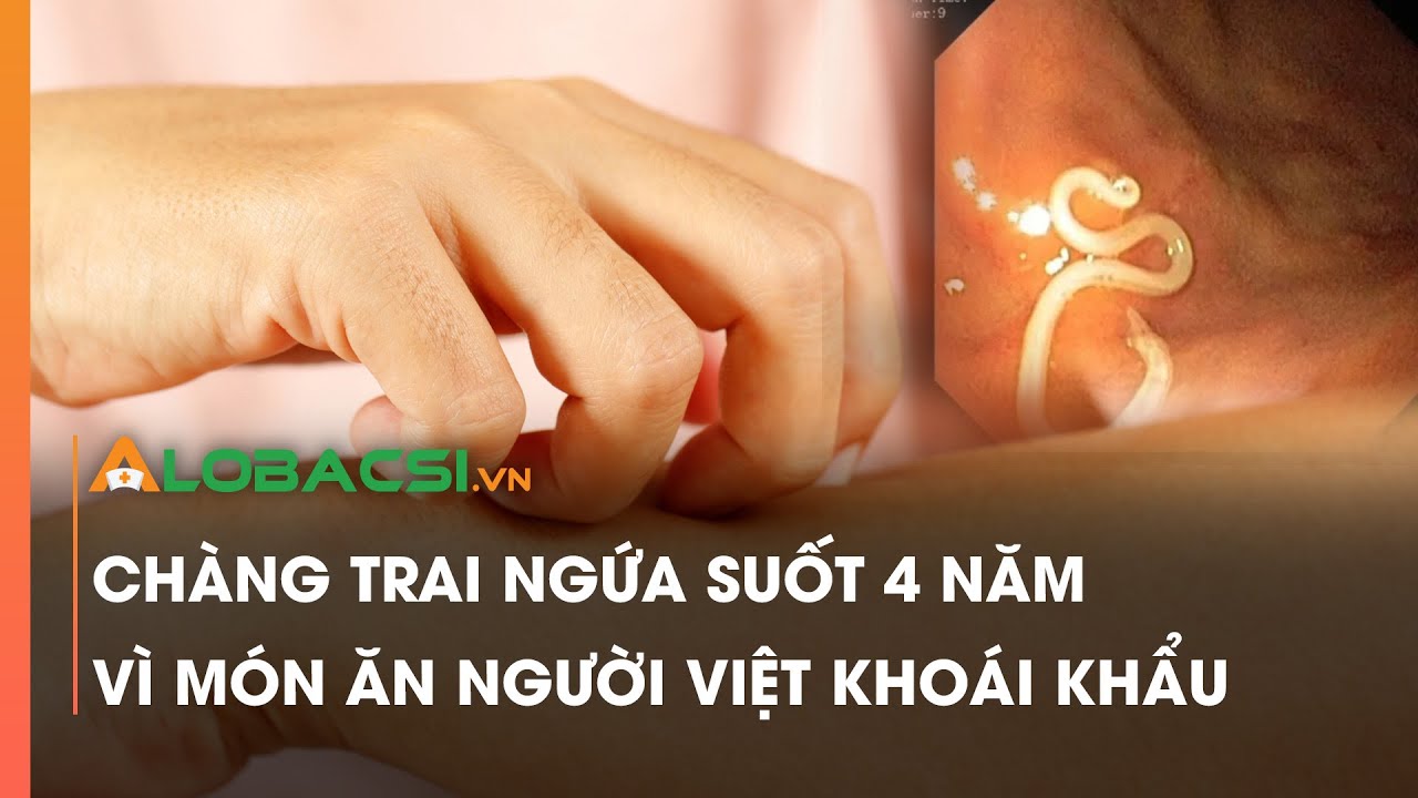 Chàng trai ngứa suốt 4 năm vì món ăn người Việt khoái khẩu