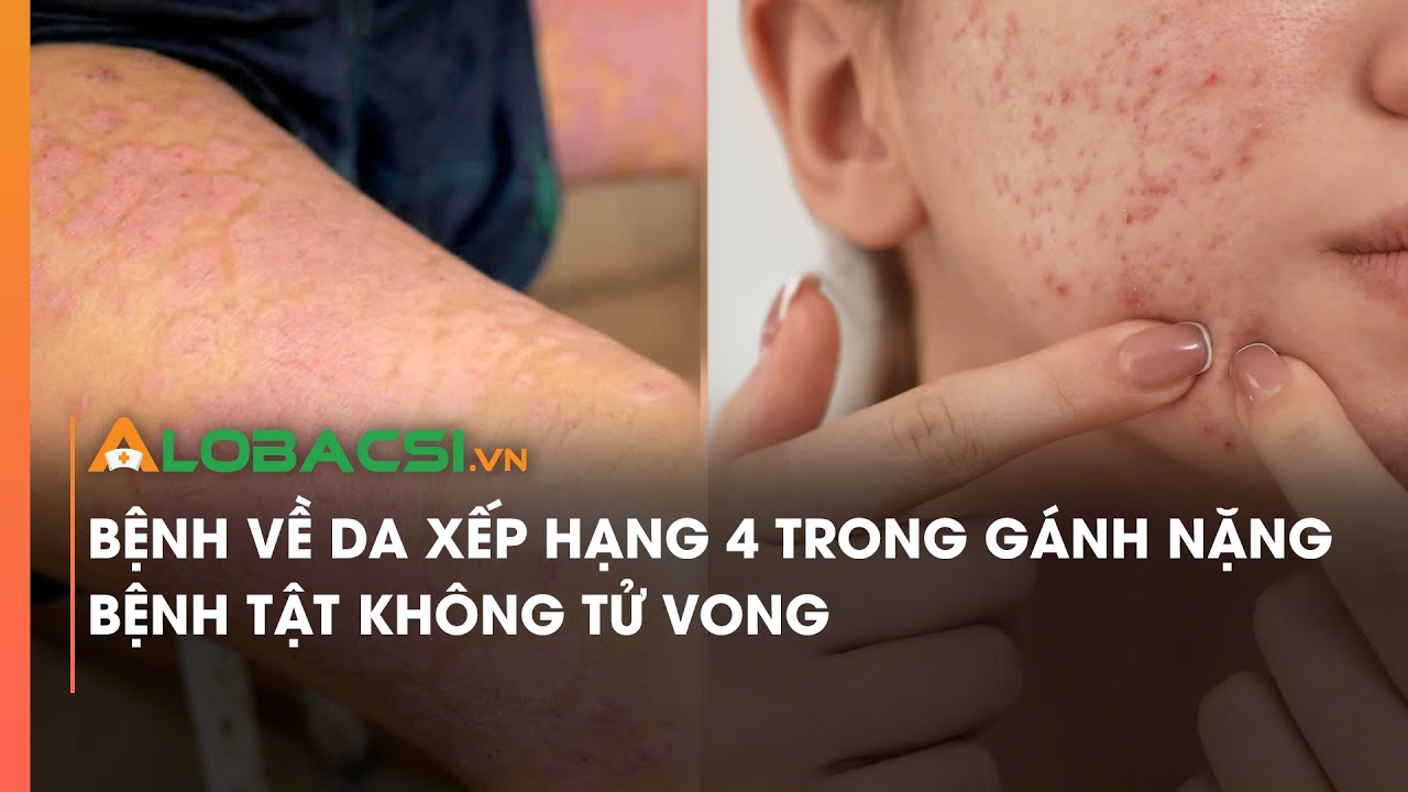 Bệnh về da xếp hạng 4 trong gánh nặng bệnh tật không tử vong