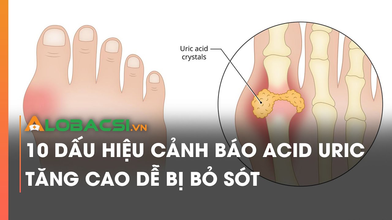 10 dấu hiệu cảnh báo acid uric tăng cao dễ bị bỏ sót