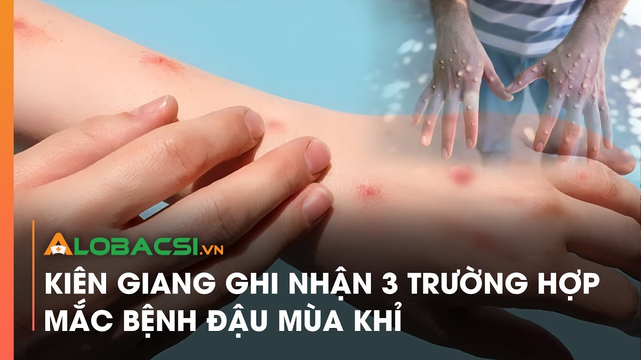 Kiên Giang ghi nhận 3 trường hợp mắc bệnh đậu mùa khỉ