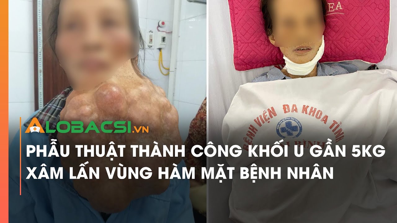 Phẫu thuật thành công khối u gần 5kg xâm lấn vùng hàm mặt bệnh nhân