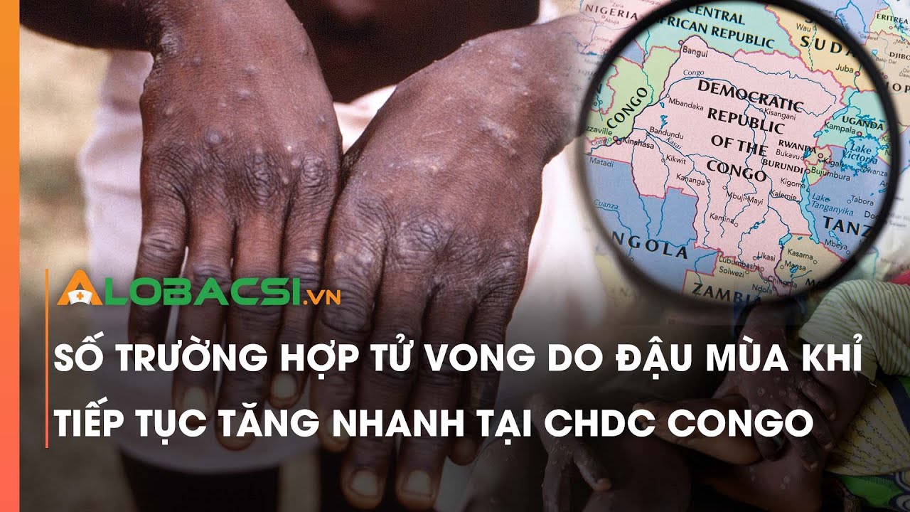 Số trường hợp tử vong do đậu mùa khỉ tiếp tục tăng nhanh tại CHDC Congo | Video Alobacsi