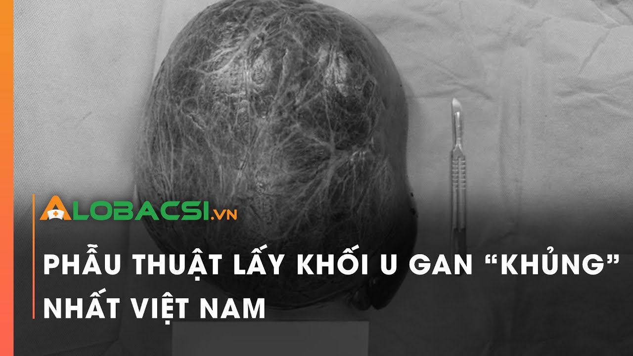 Phẫu thuật lấy khối u gan 'khủng' nhất Việt Nam