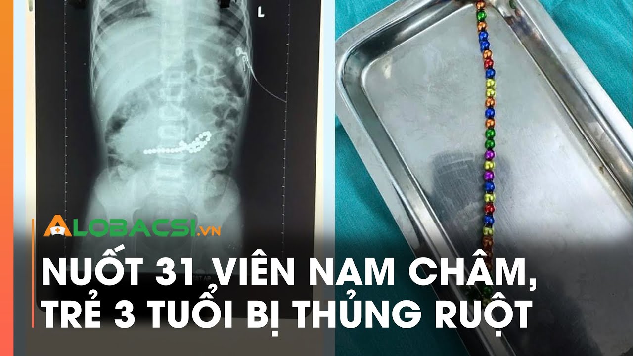 Nuốt 31 viên nam châm, trẻ 3 tuổi bị thủng ruột | Video Alobacsi