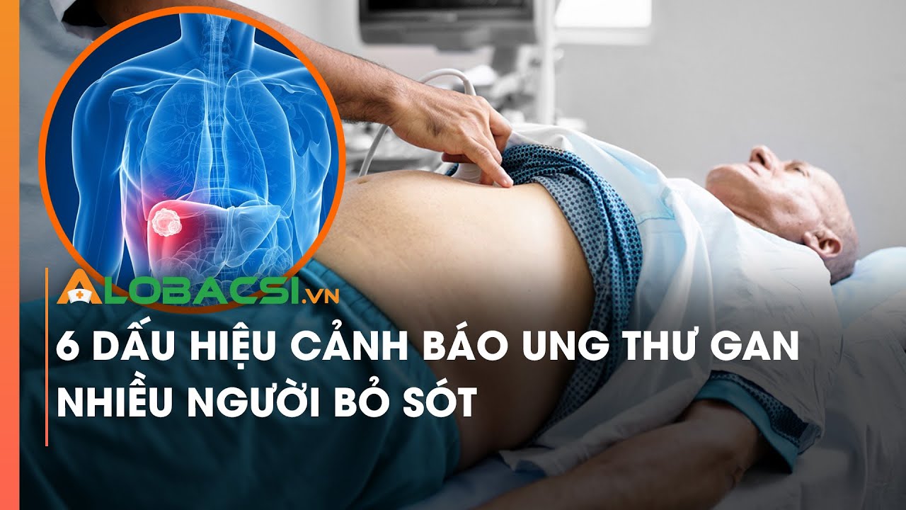 6 dấu hiệu cảnh báo ung thư gan nhiều người bỏ sót