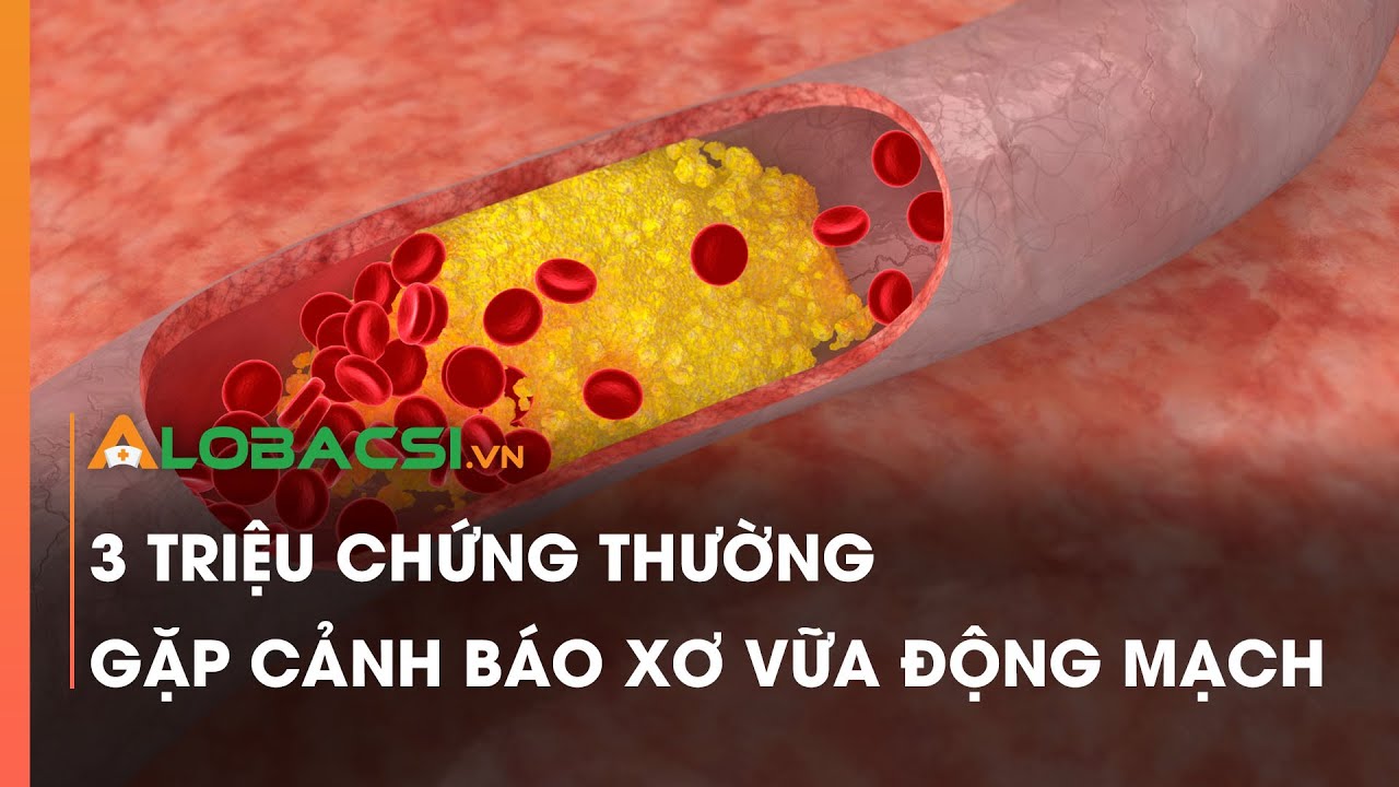 3 triệu chứng thường gặp cảnh báo xơ vữa động mạch