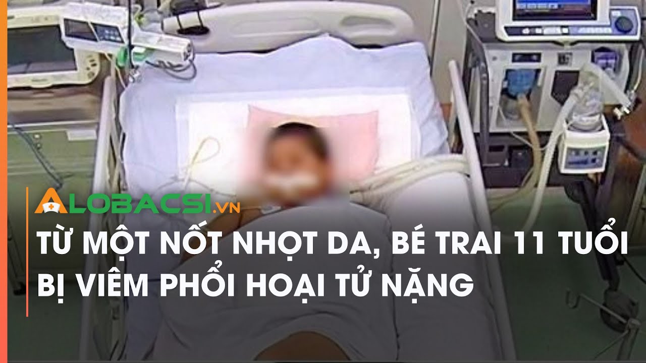 Từ một nốt nhọt da, bé trai 11 tuổi bị viêm phổi hoại tử nặng