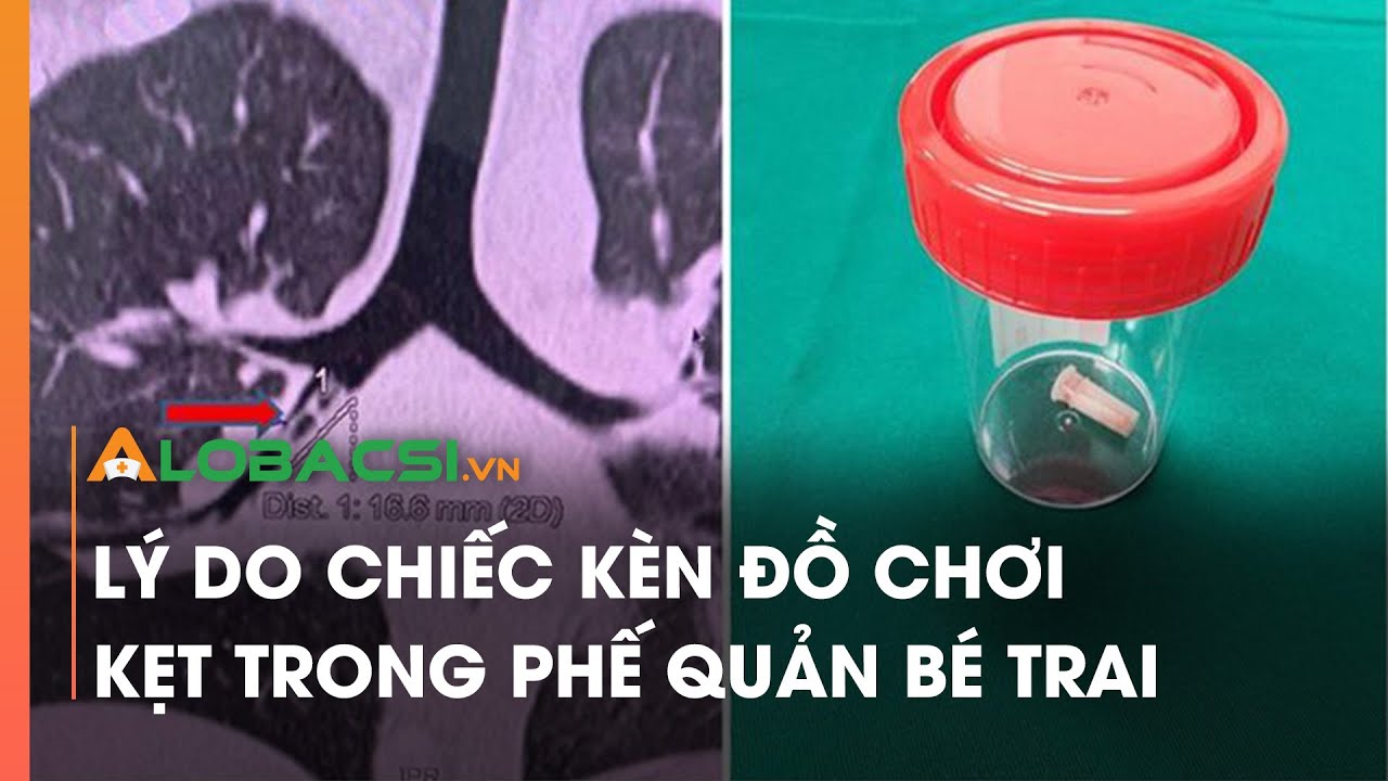 Lý do chiếc kèn đồ chơi kẹt trong phế quản bé trai