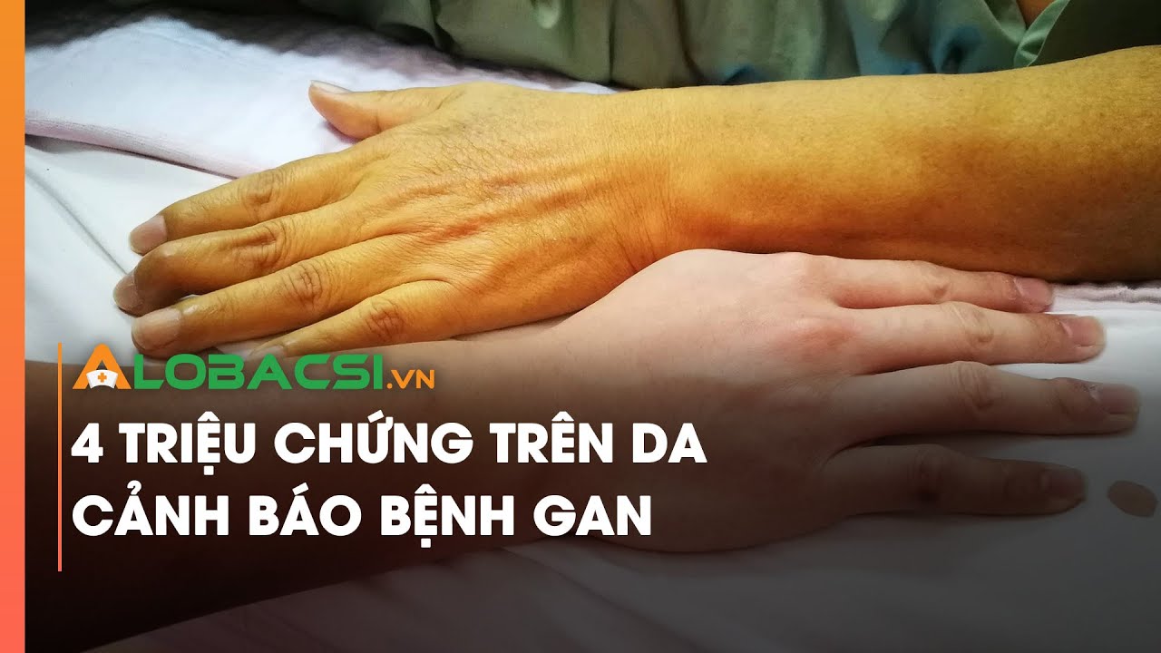 4 triệu chứng trên da cảnh báo bệnh gan