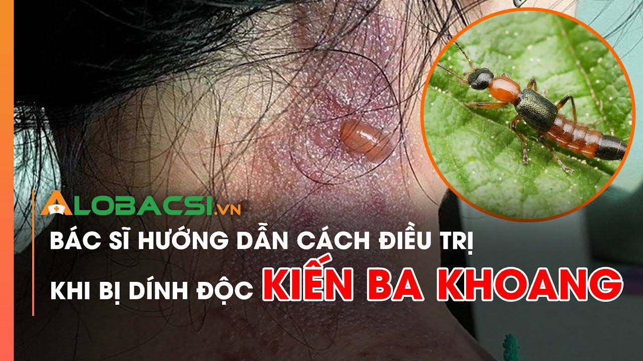 Bác sĩ hướng dẫn cách điều trị khi bị dính độc kiến ba khoang